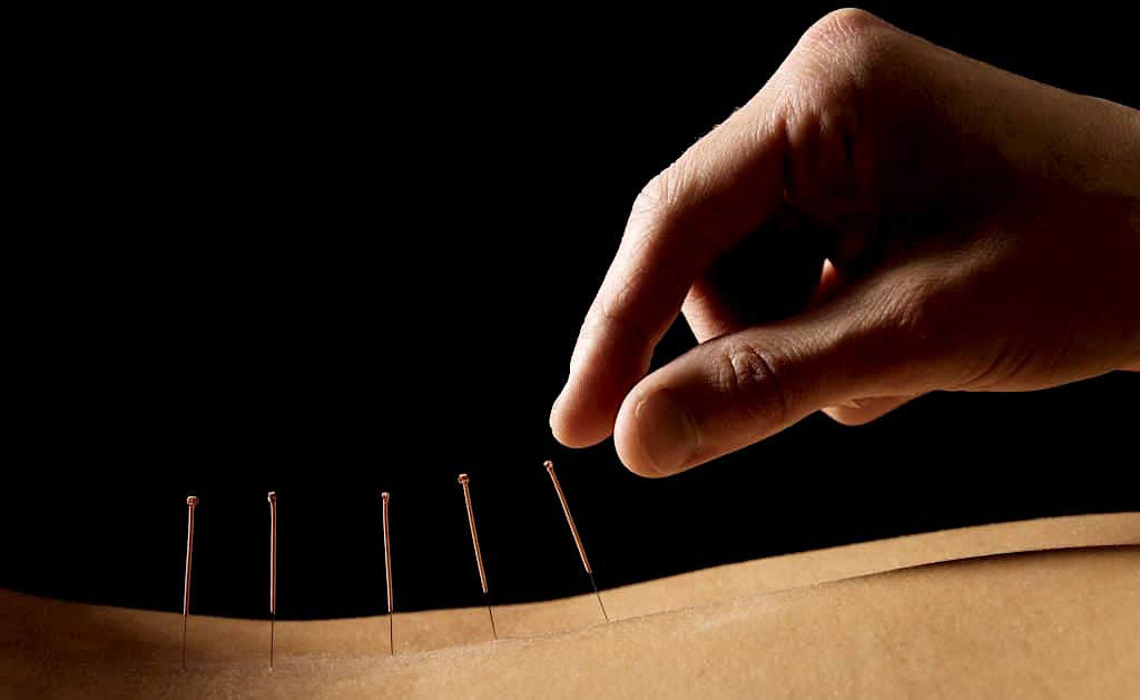 Acupuncture with Electro-Stimulation in Santa Monica/Los Angeles